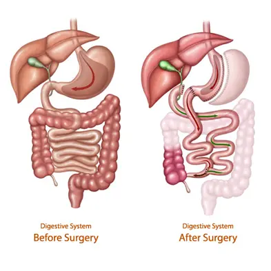 Bariatric Surgery 