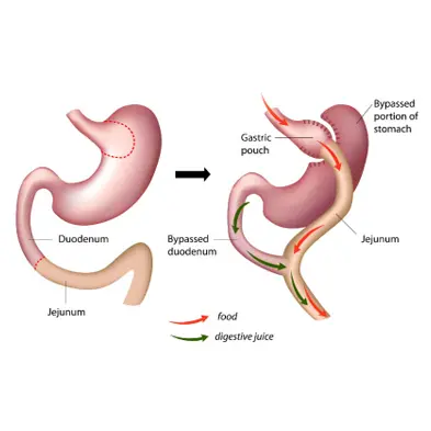 Bariatric Surgery 